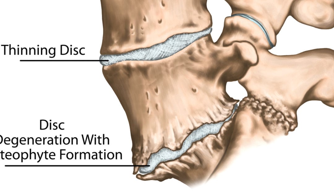 Bone Spurs of the Spine – What Causes Them and How Can They Be Treated?