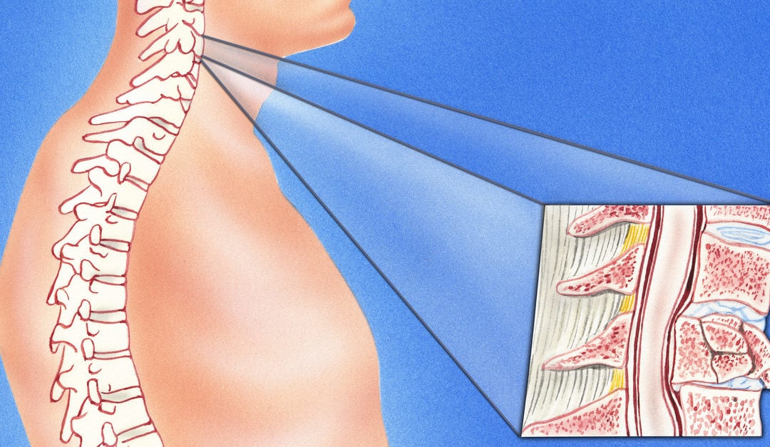 cervical spine fracture