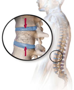 vertebral stress fracture