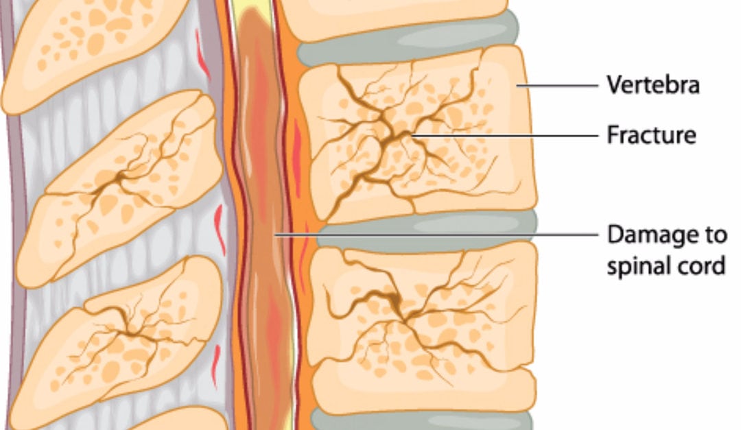 How Osteoporosis Affects the Spine