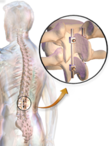 cervical fusion