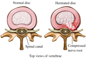 slipped disc