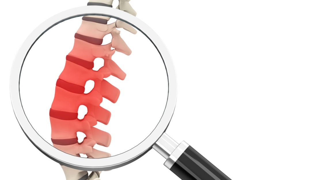 The 3 Most Common Reasons Why a Spinal Disc Slips