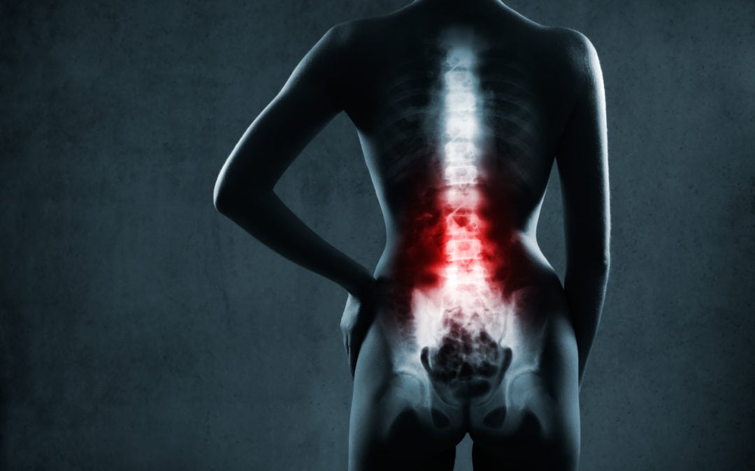 I Was Told I Have Lumbar Spinal Stenosis…What Does That Mean?