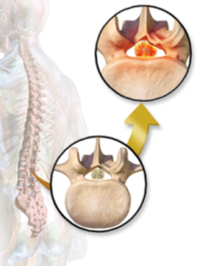 spinal stenosis