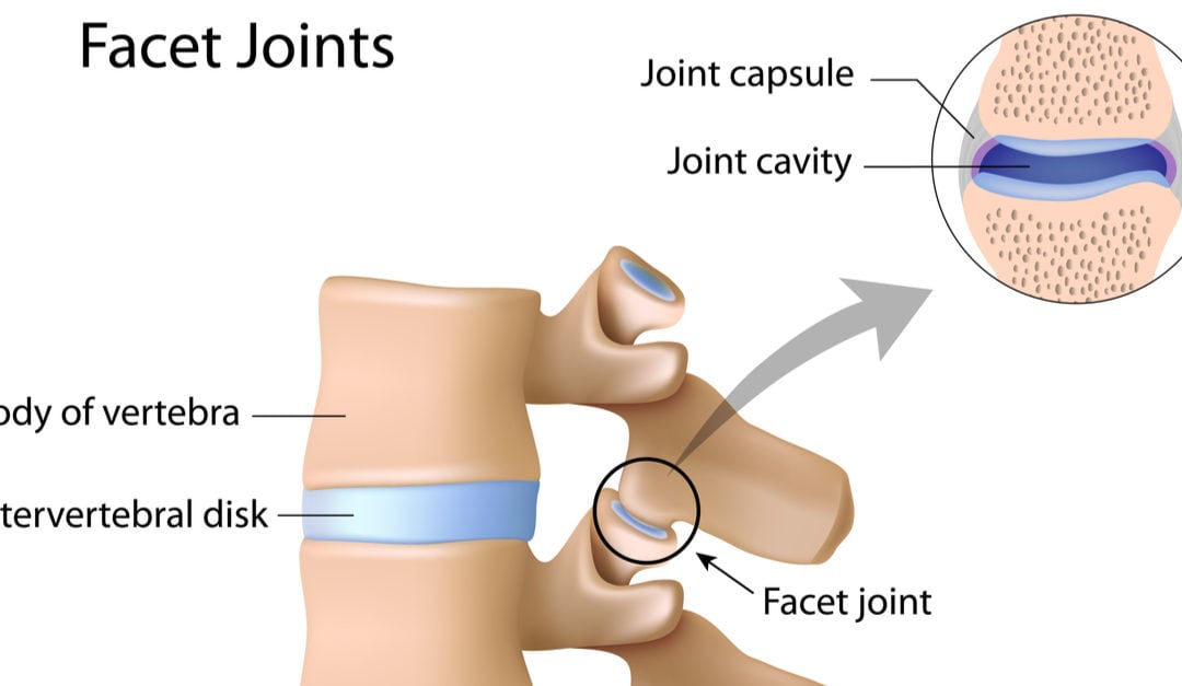 facet joint arthritis